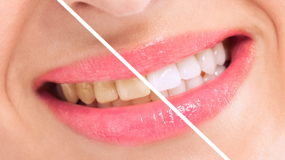 Ben-essere e denti bianchi: quando “sbiancare” funziona veramente