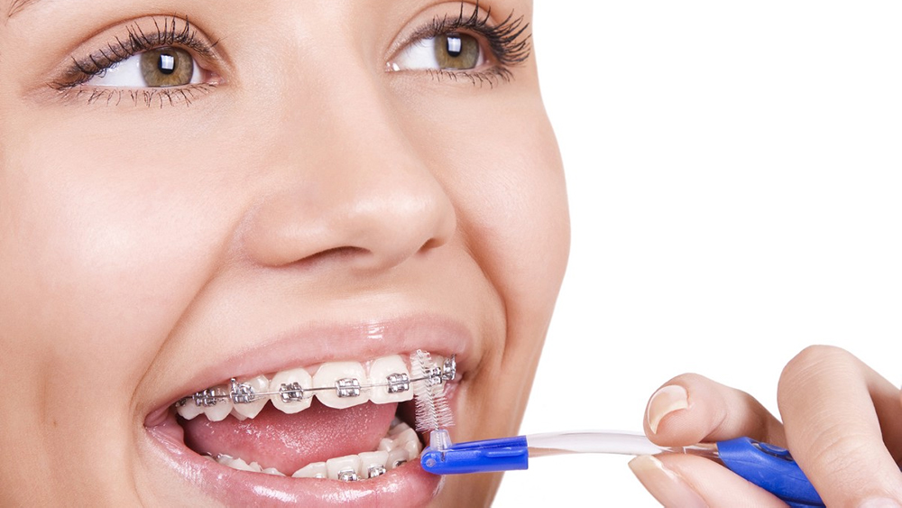 Le emergenze dell’apparecchio ortodontico